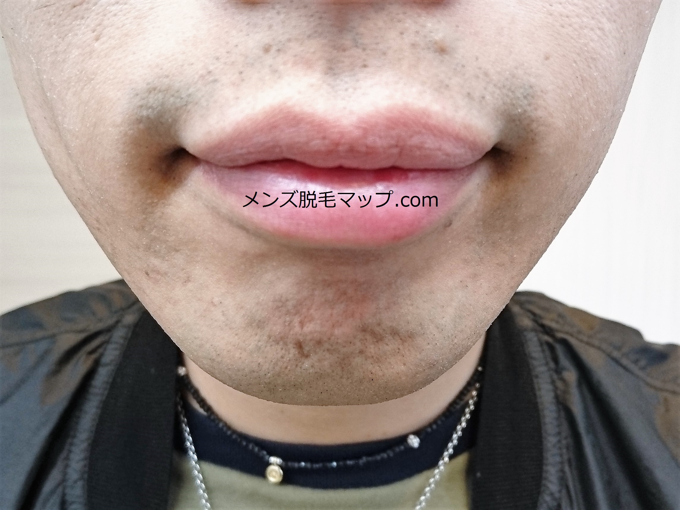 【ヒゲ脱毛】医療脱毛体験談！何回で綺麗になれるのか！？（２回目）